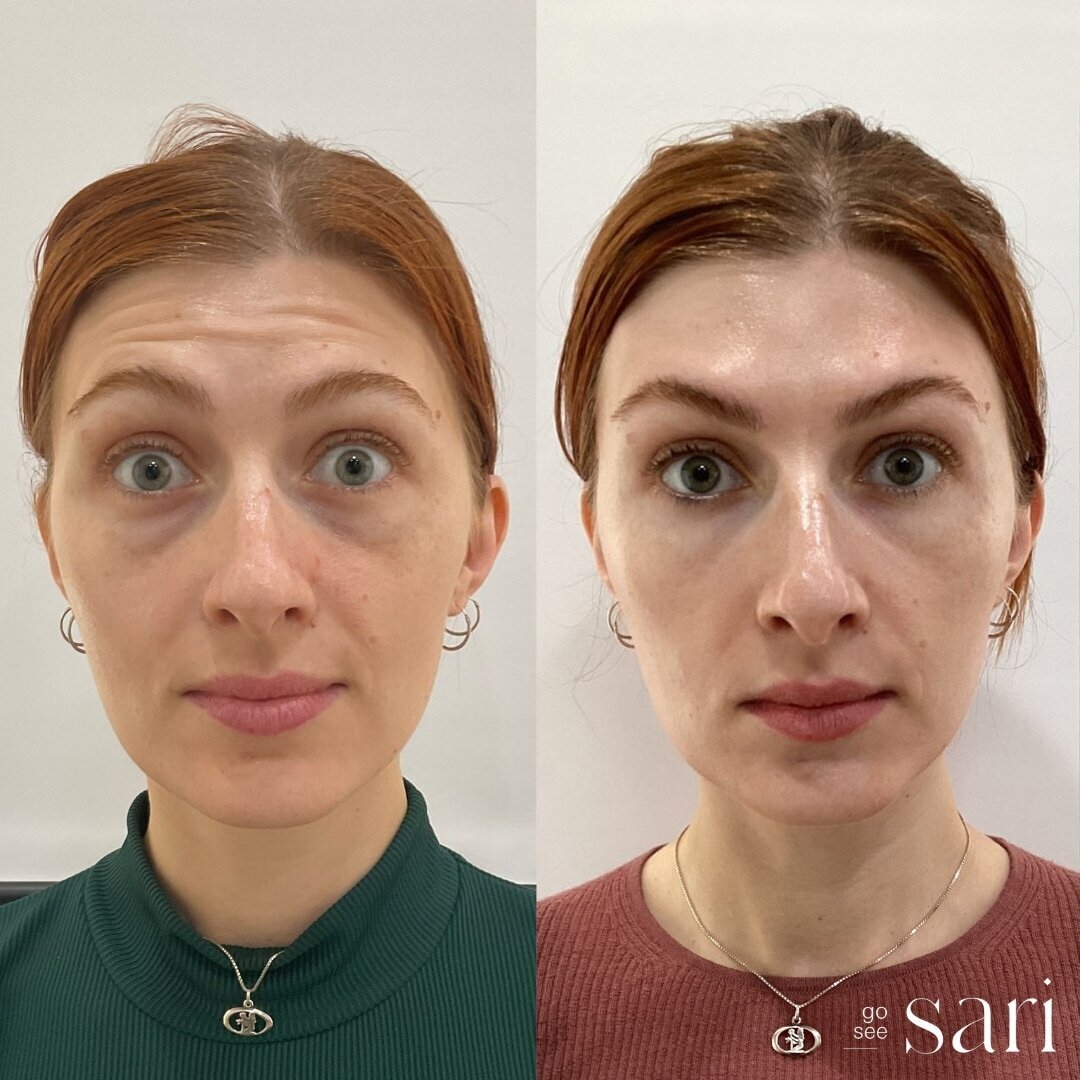Go See Sari_Botox 1
