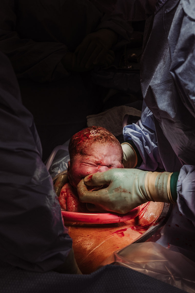 cesarean-birth-photography-natalie-broders-d-075