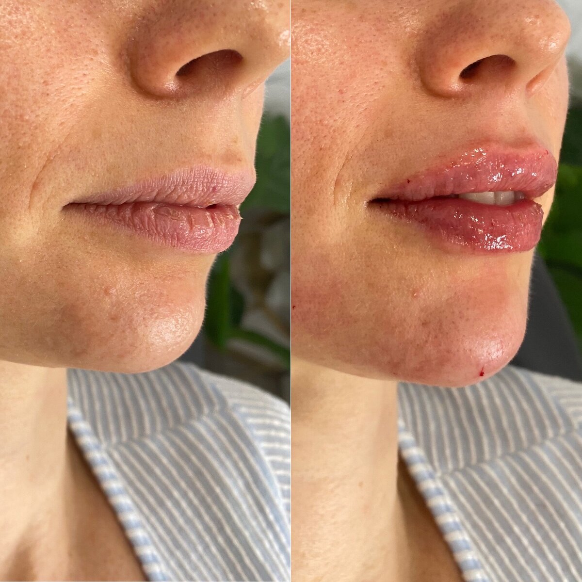BalancedBeautyBotoxWestwood11