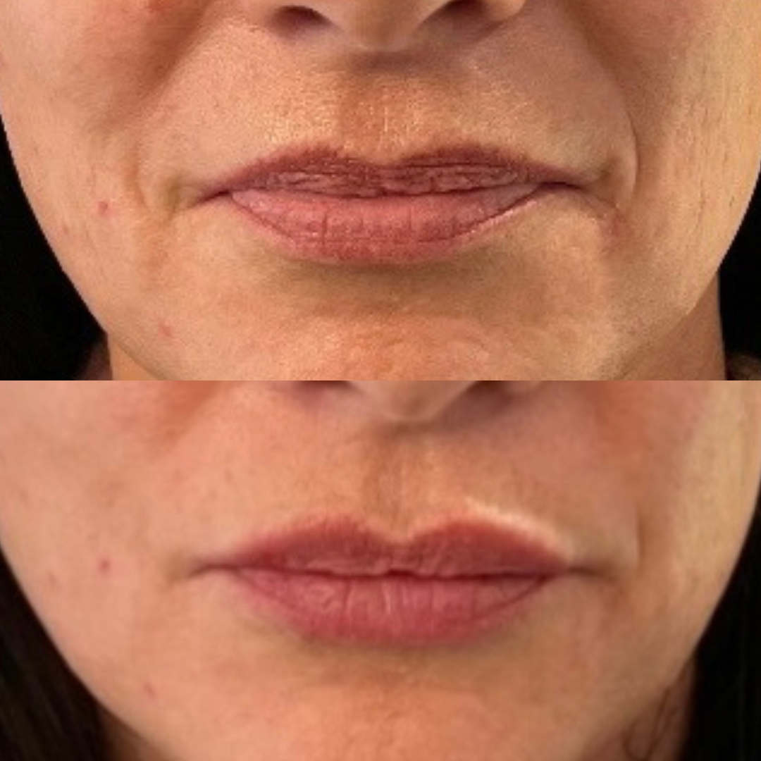 Lip enhancement with Juvederm Vobella