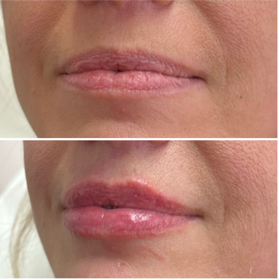 compressed-Lip-Wrinkles- Lip-volume-nd-some-brand-pics-18
