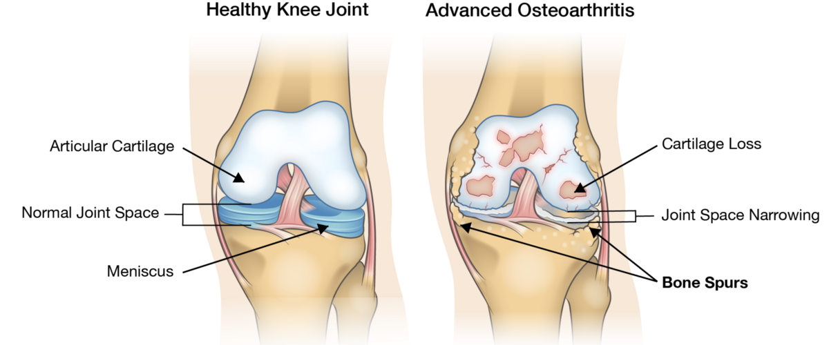 Comparison image of a healthy knee joint and an advanced ostheoarthritis