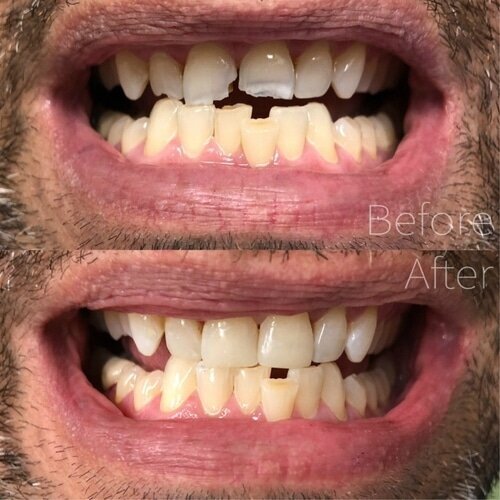 after-1-bondedfillingsonthreeupperfrontteethduetodecayandheavywearing-p-500
