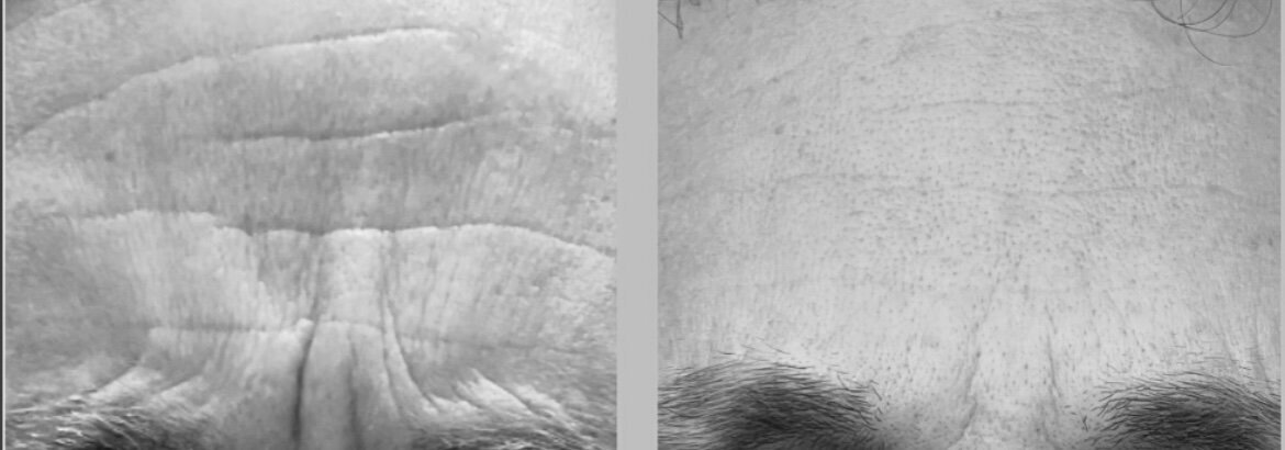 before and after botox on male forehead and 11's
