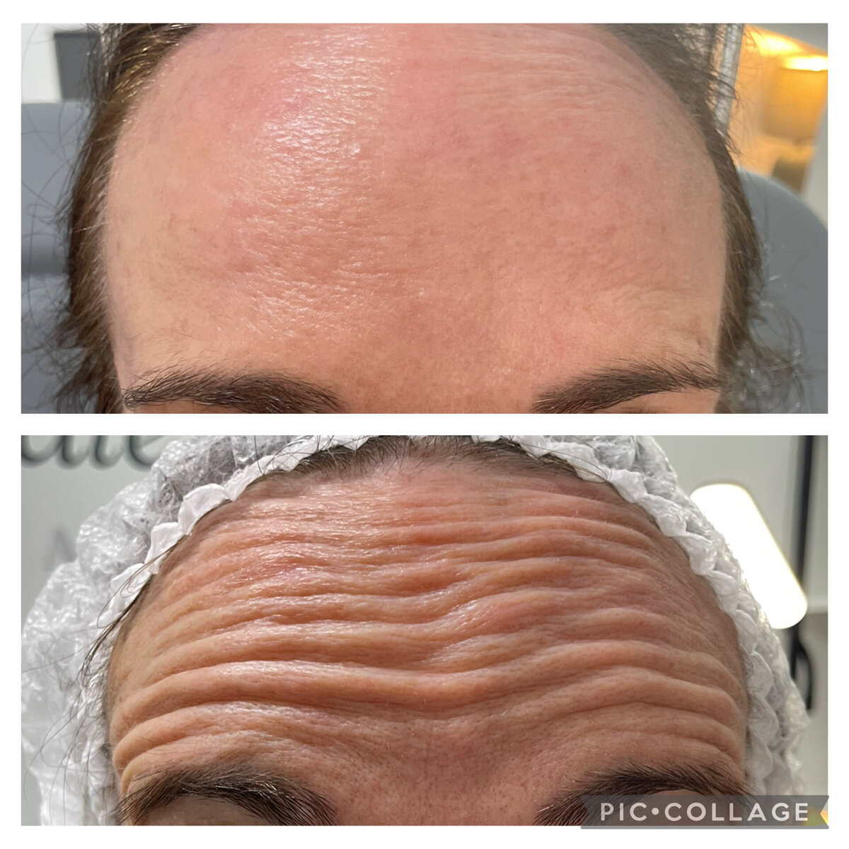 antiwrinkle injections in norwich based clinic aesthetic practitioner