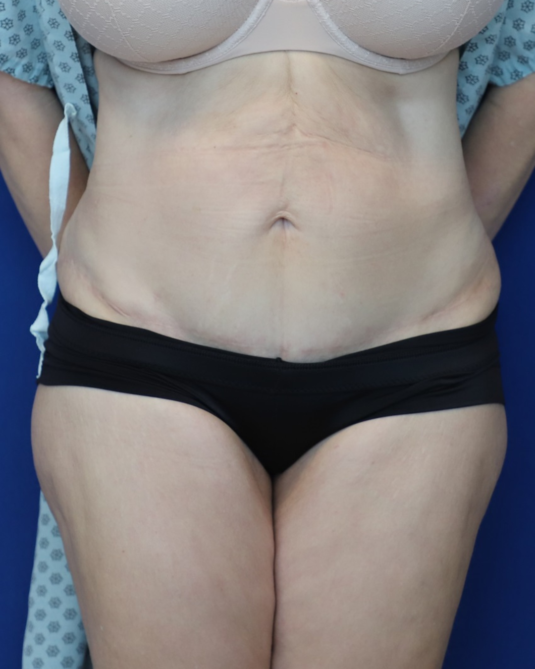 before after-2
