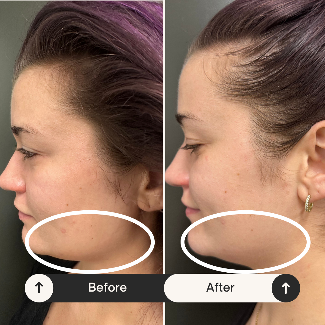 Buccal before after 1