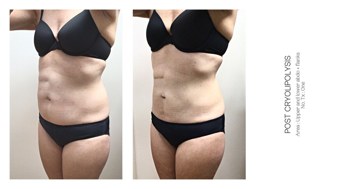 Cryolipolysis Stomach Before and After 2
