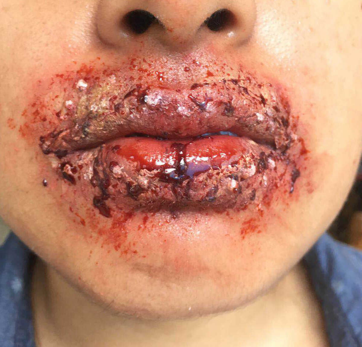 Special effects - blistered lips