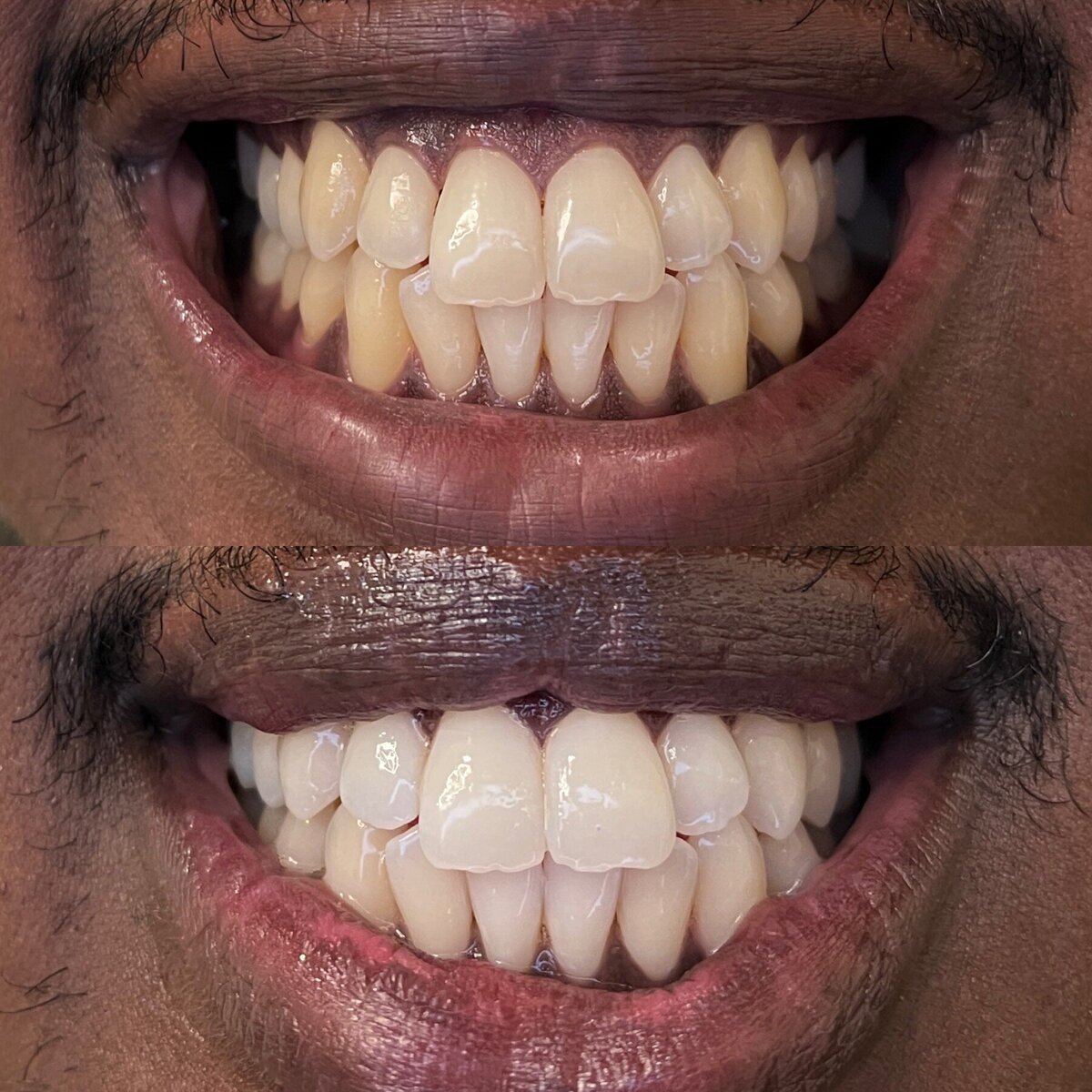 teeth whitening portland oregon or pdx tooth fairy