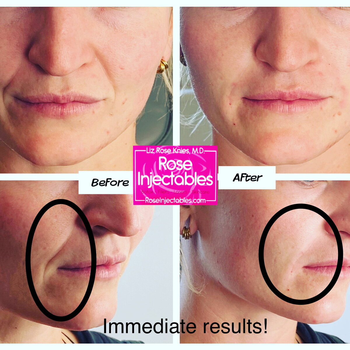 Fillers-by-Rose-Injectables-Before-and-After-Photos-39
