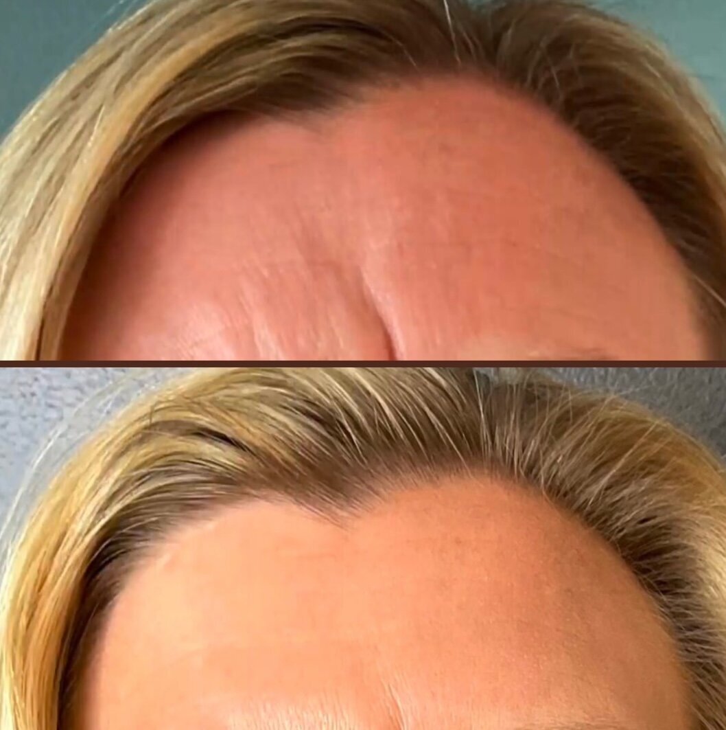 first time botox to glabella