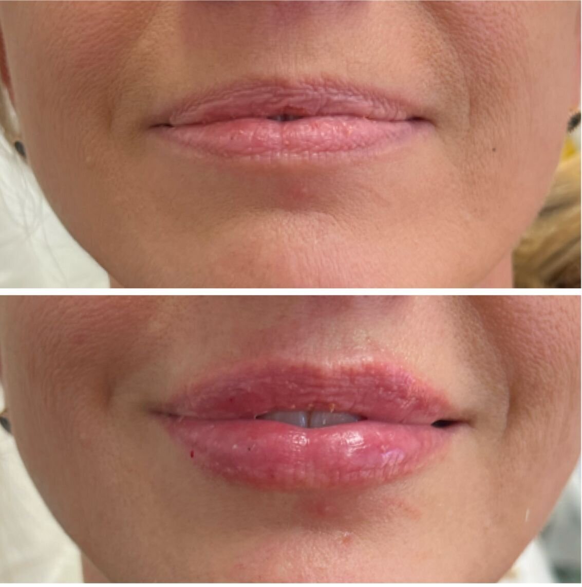 compressed-Lip-Wrinkles- Lip-volume-nd-some-brand-pics-19