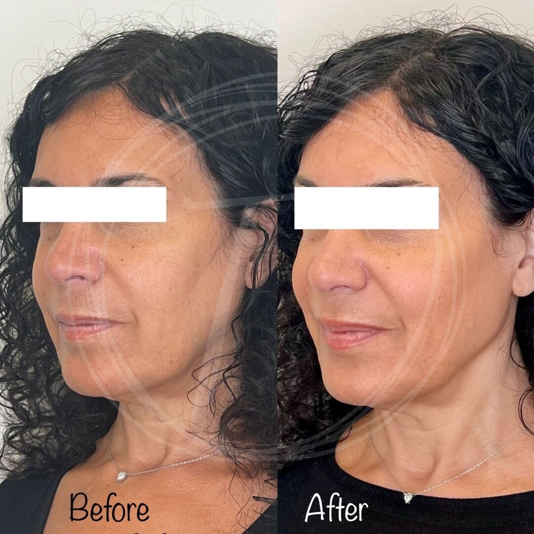 before:after results with look timeless - 13