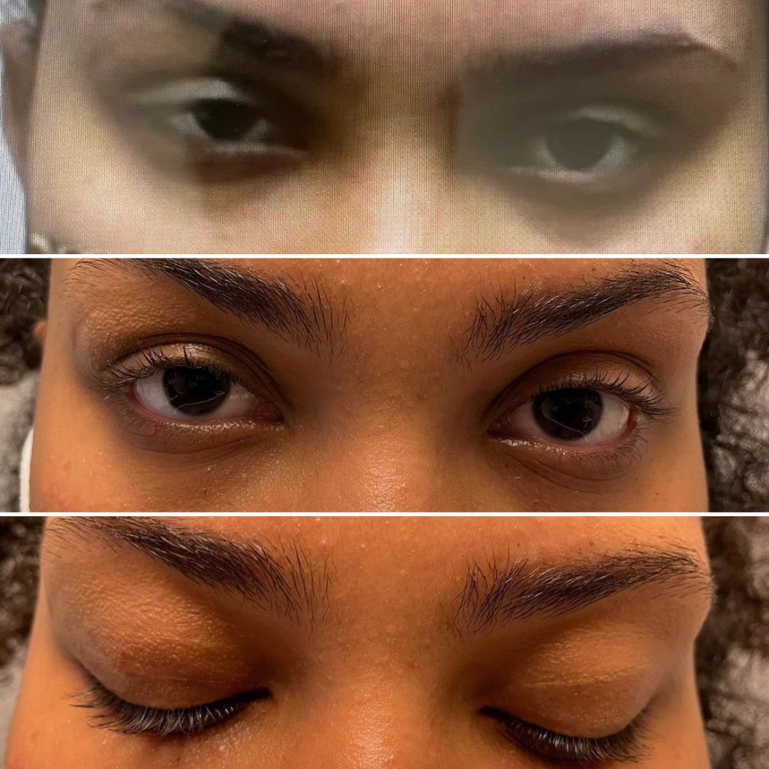 ptosis surgery right eye(1)