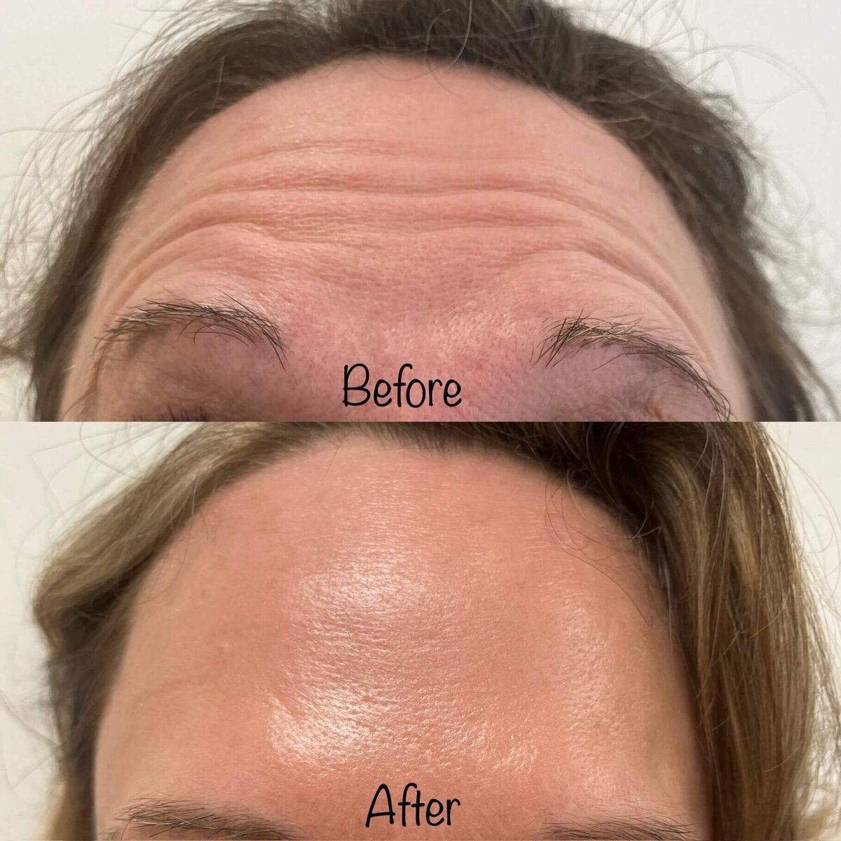 before-after-results-botox-wrinkles