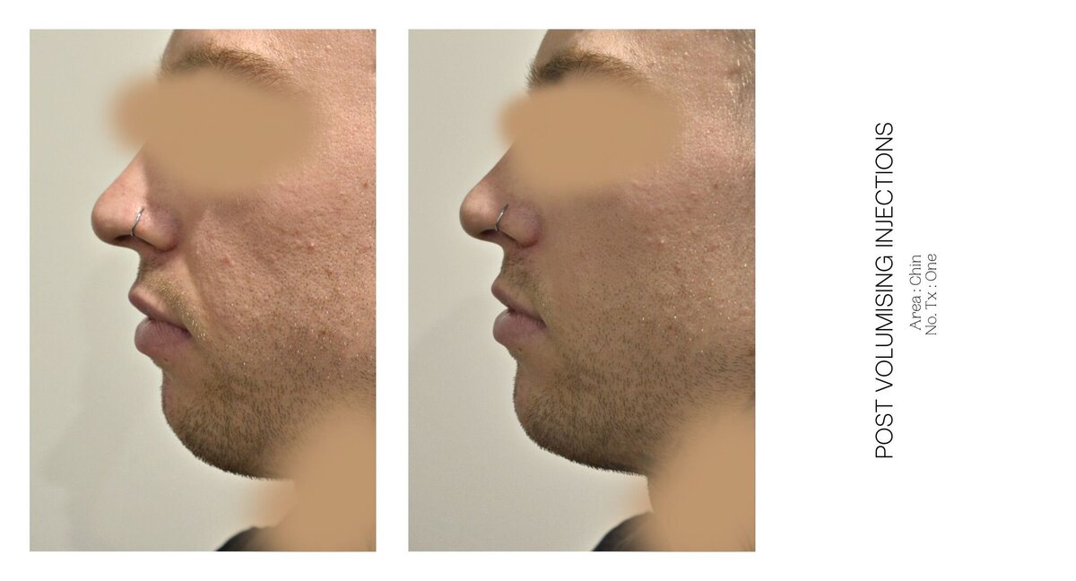 Chin Injections Before and After 1