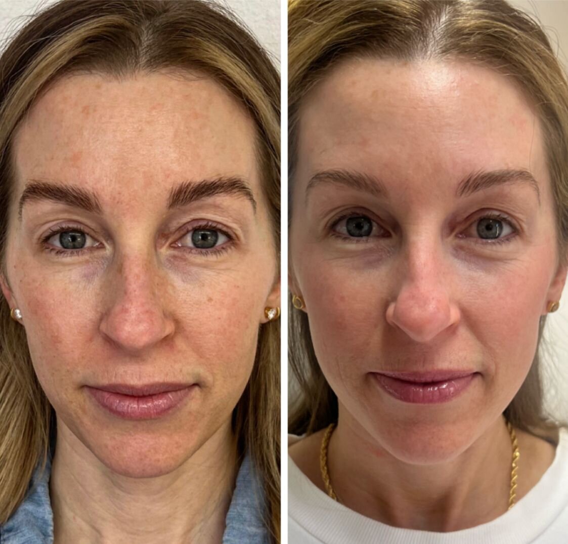 compressed-BBL-HALO-before-after-06