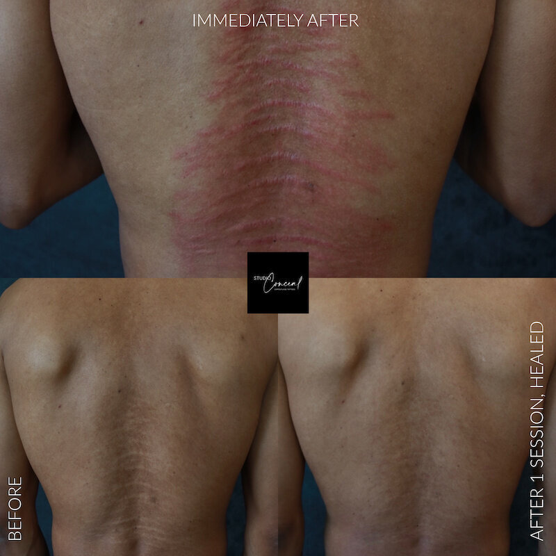 Male-stretch-marks-back-3