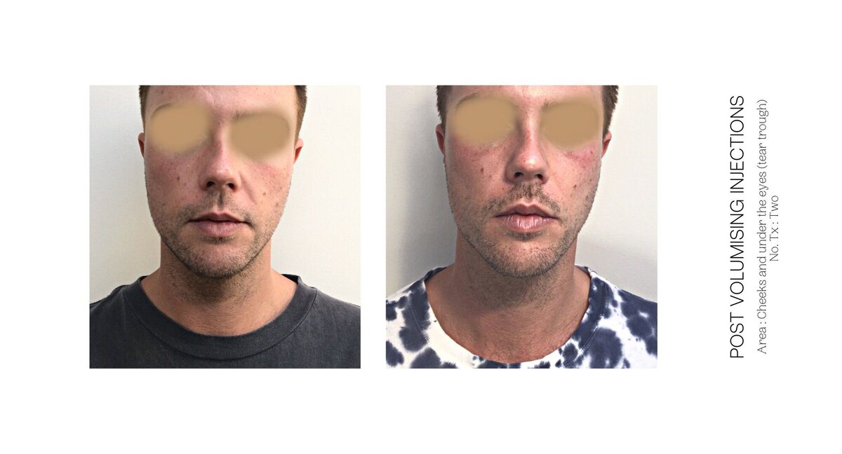 Male Cheek Injections Before and After