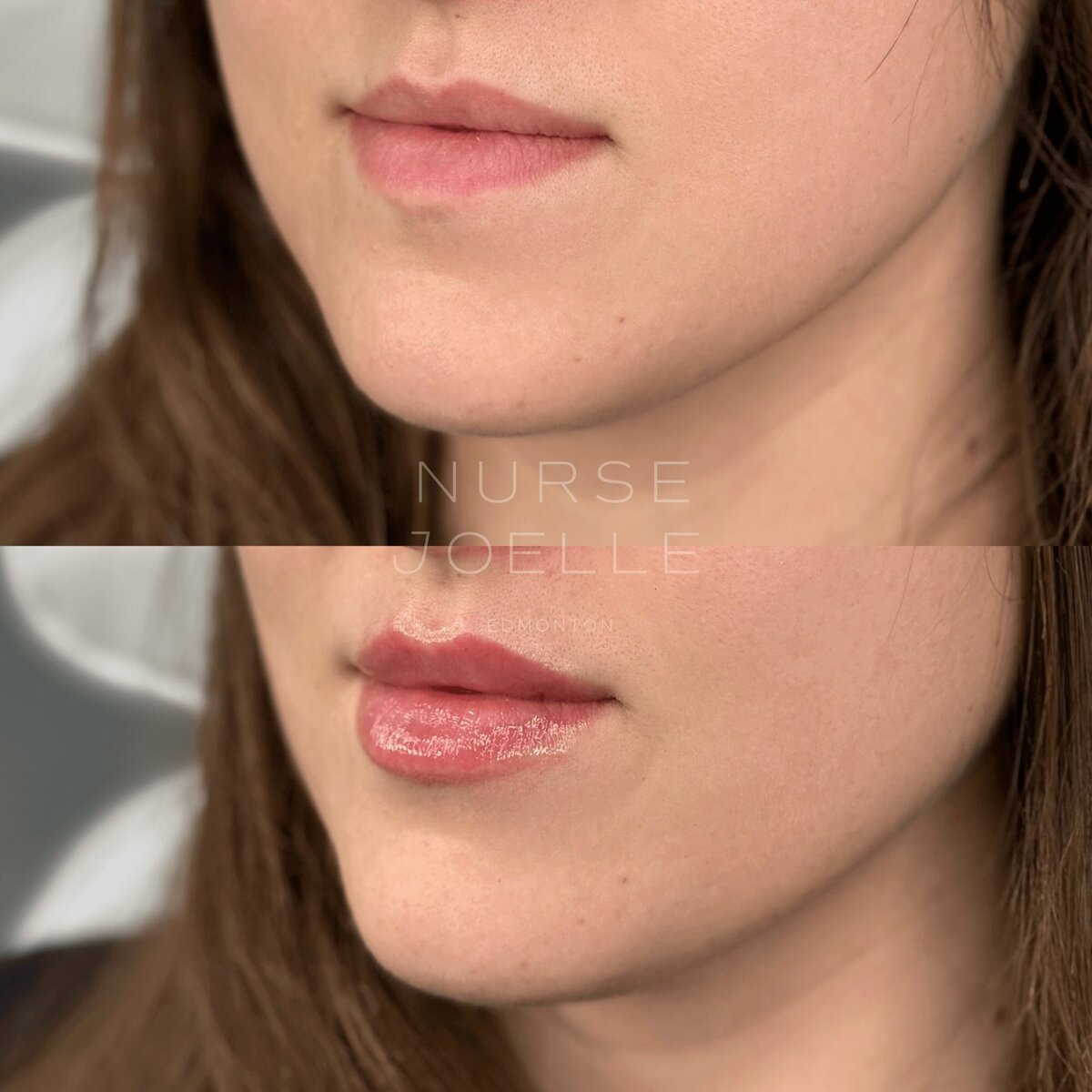 Nurse-Joelle-Cosmetic-Injectables-Before-and-After-13