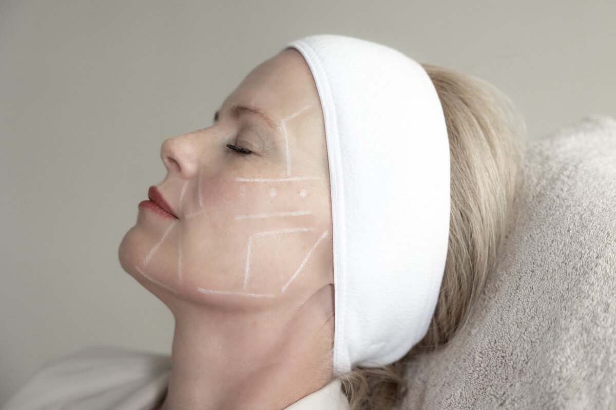 Liquid facelift door drs Lizenka Adriaanse cosmetisch arts Rotterdam