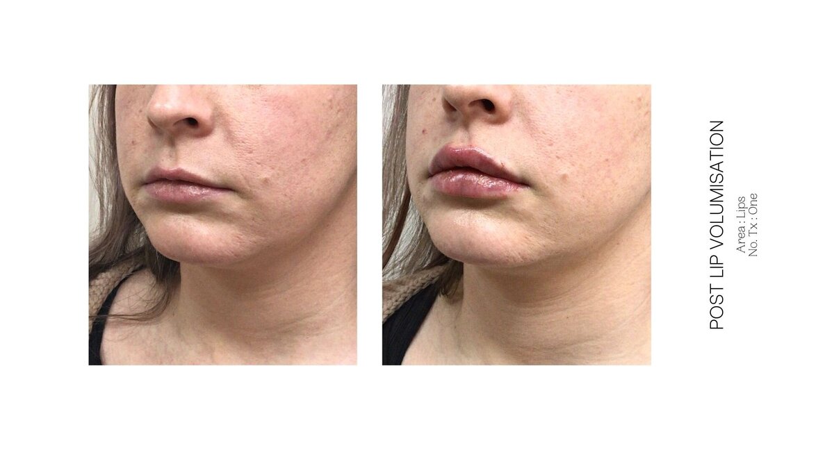 Best South Coast Lip Injection Before and After 30