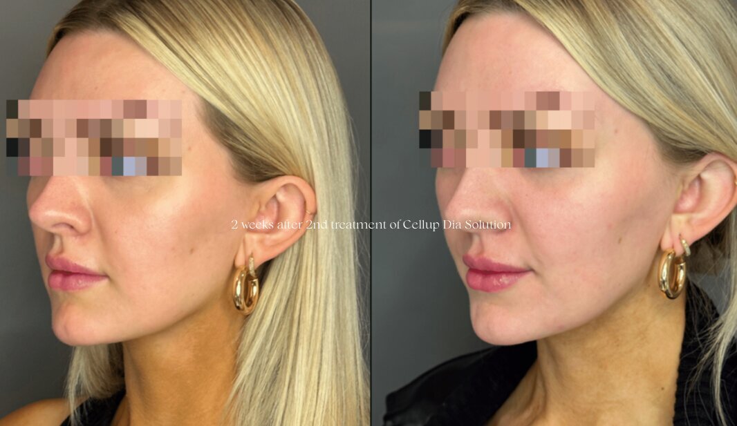 klaride-skin-booster-before-after-2