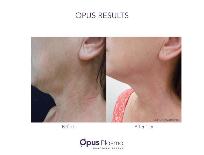 Opus Results Picture 1