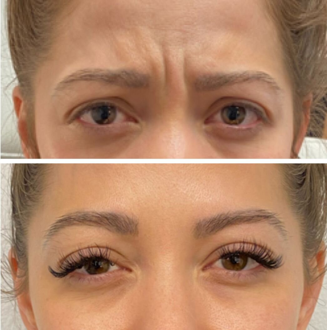 compressed-Neuromodulator-before-after-10