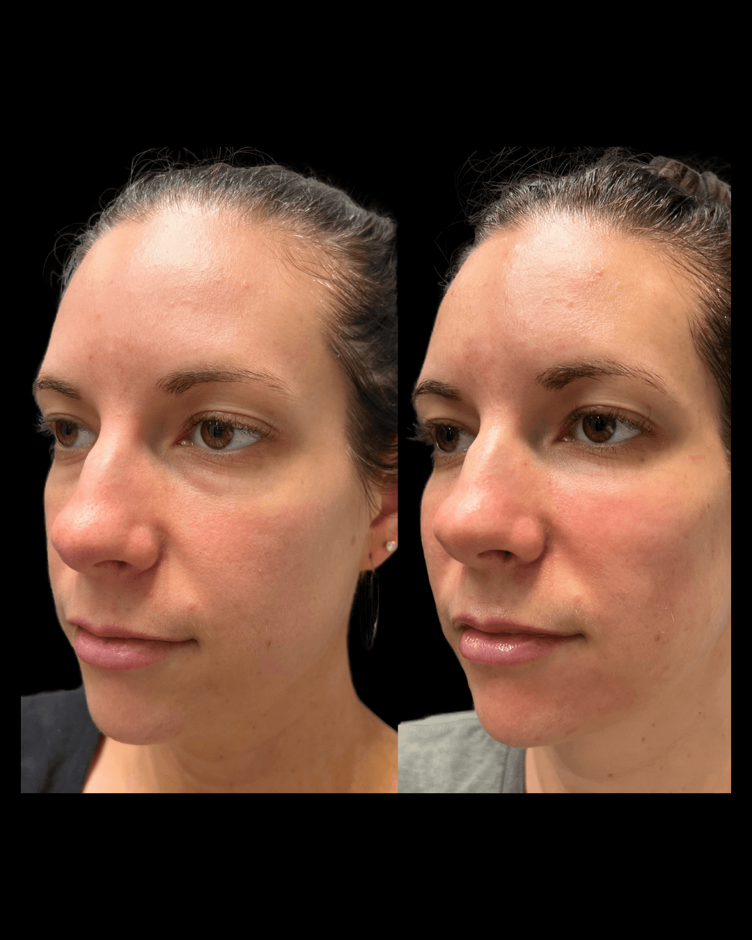 Maxwell-Aesthetics-Salem-Oregon-Results-4