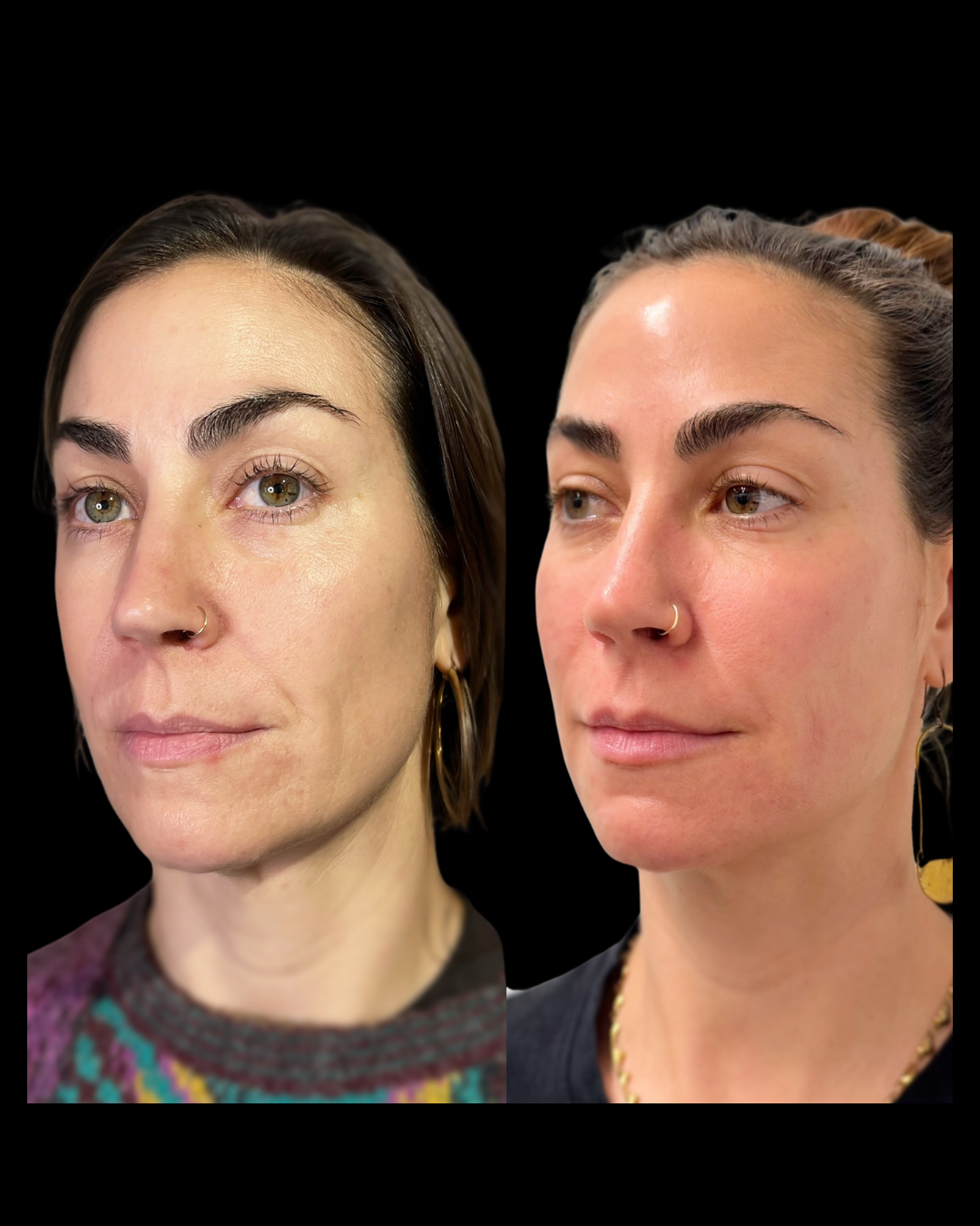 Before-and-after results from facial balancing treatments at Maxwell Aesthetics in Salem, Oregon, including Botox, dermal fillers, lip enhancements, and lower face rejuvenation—designed to enhance natural symmetry and restore youthful contours.