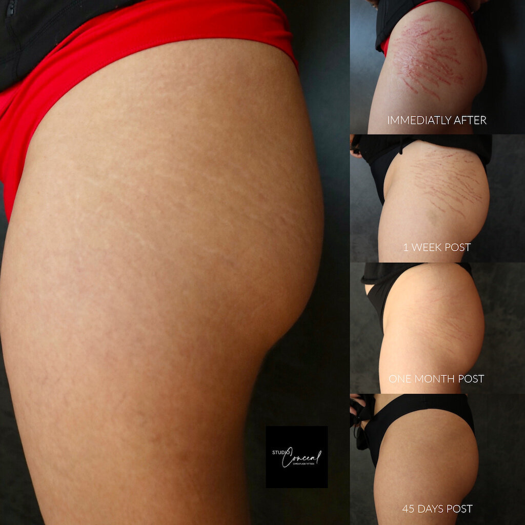 stretch-mark-cover-up-tattoo