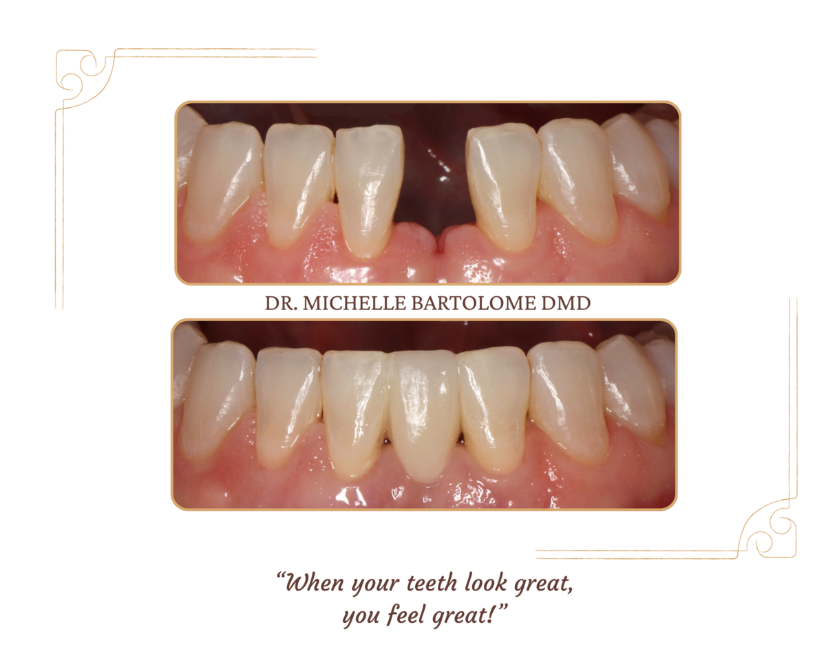 Replace Missing Teeth (3)