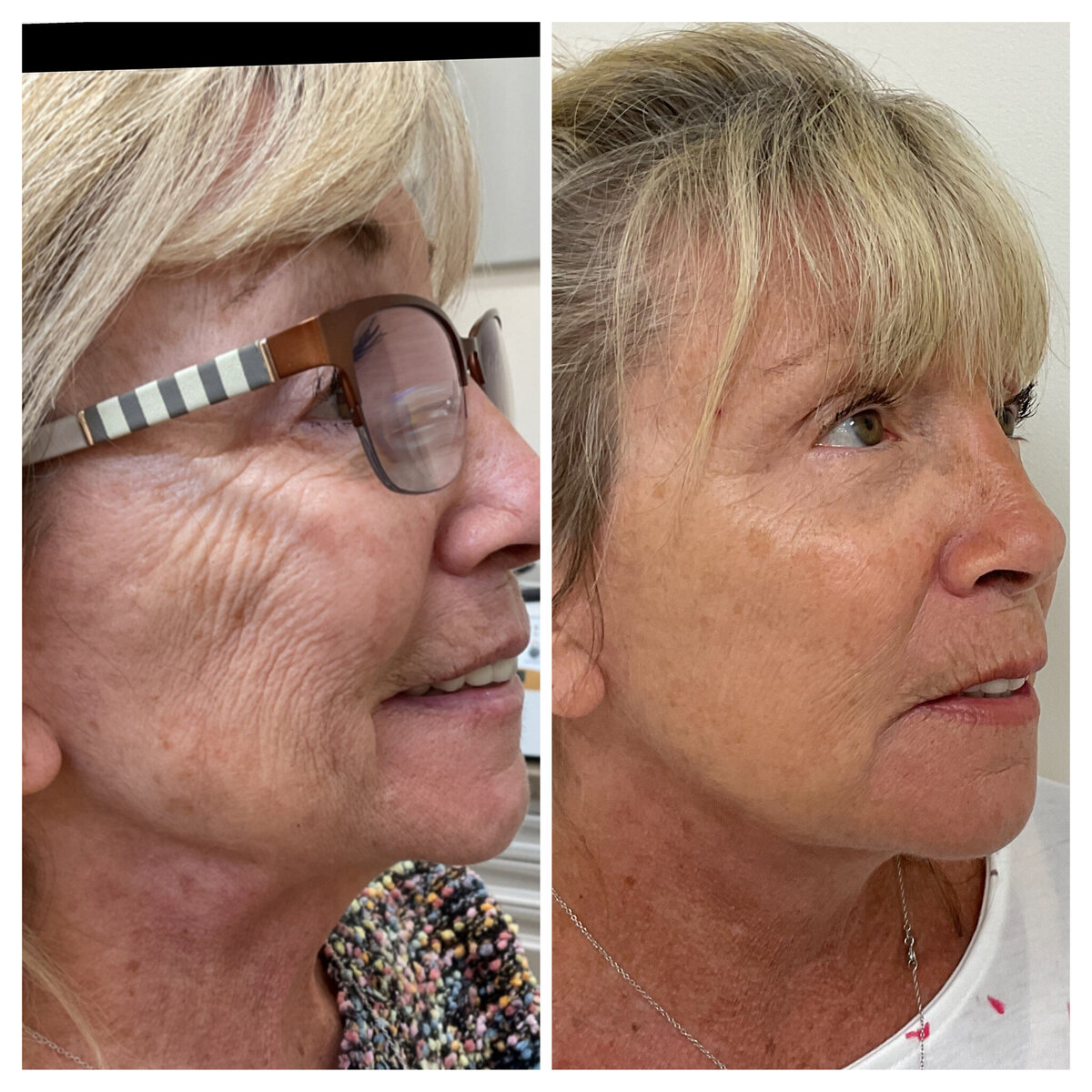 Botox filer and wrinkle reduction for a natural, youthful glow