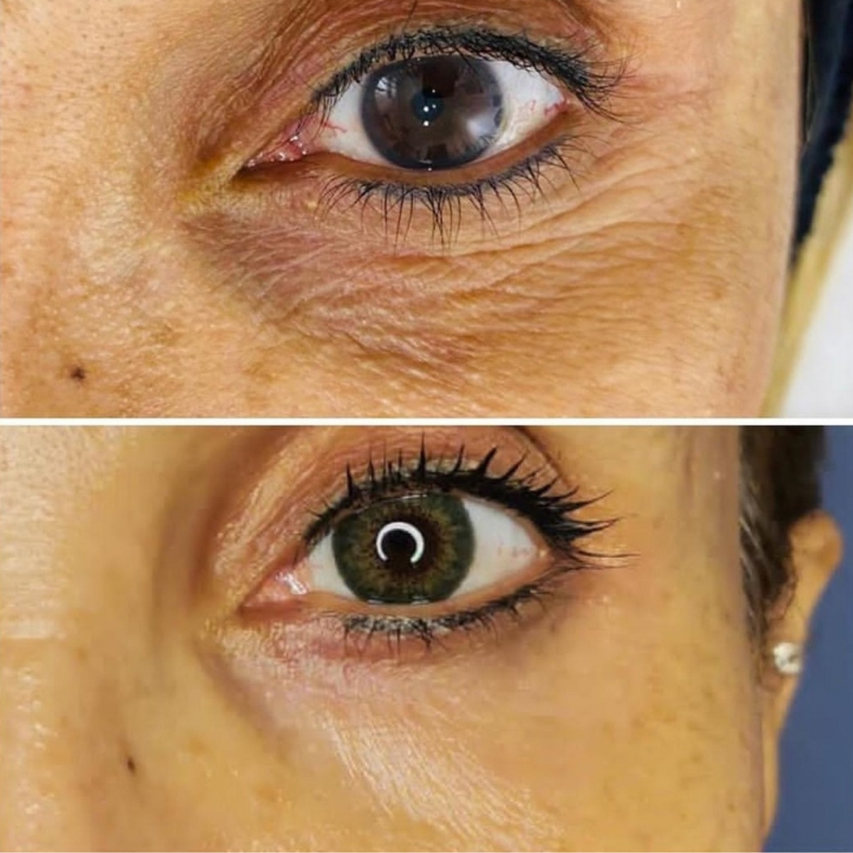 Bhlepharoplasty