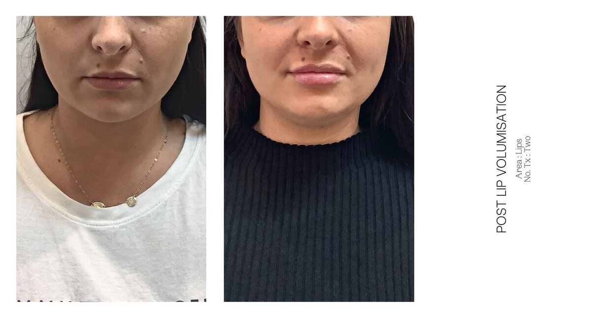 Best South Coast Lip Injection Before and After 15