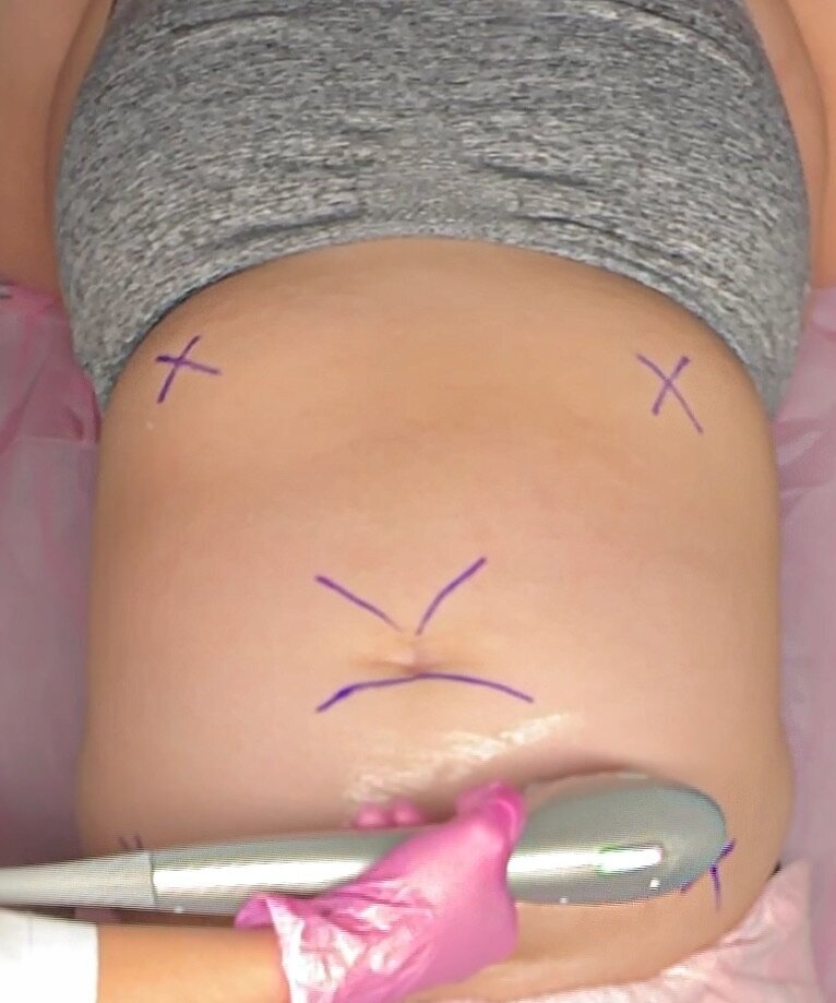 hifu stomach with guide lines