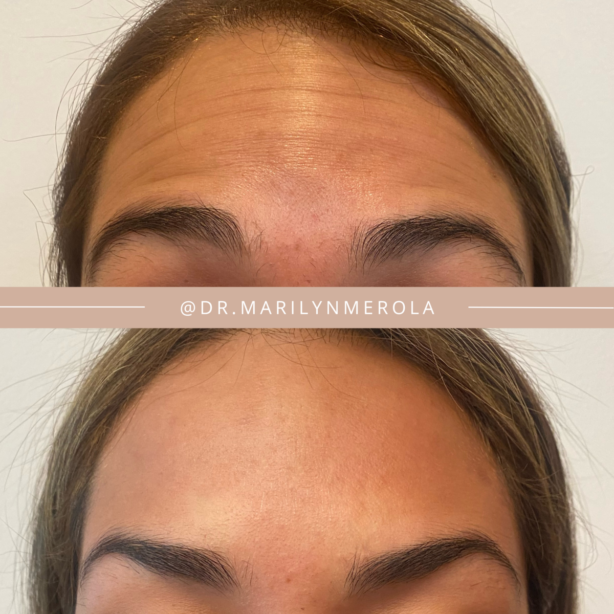 Xeomin B&A