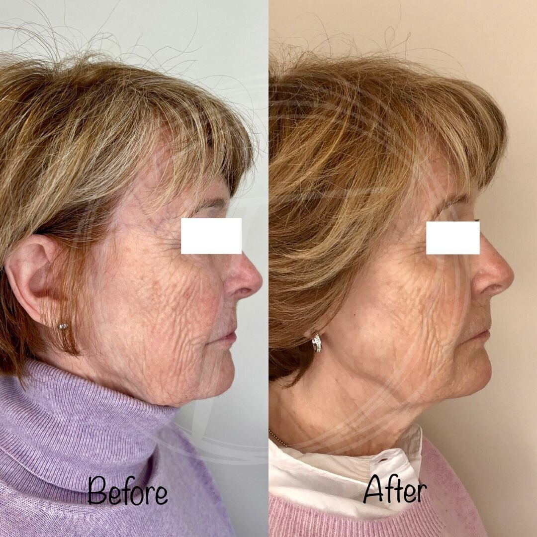 before:after results with look timeless - 14
