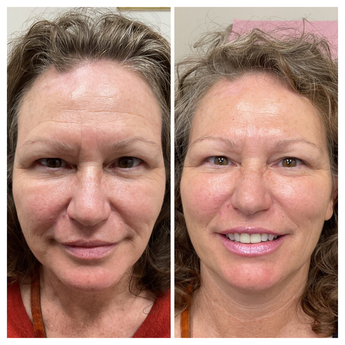 Botox and filler for lifted, smoothed, enhanced natural looking beauty