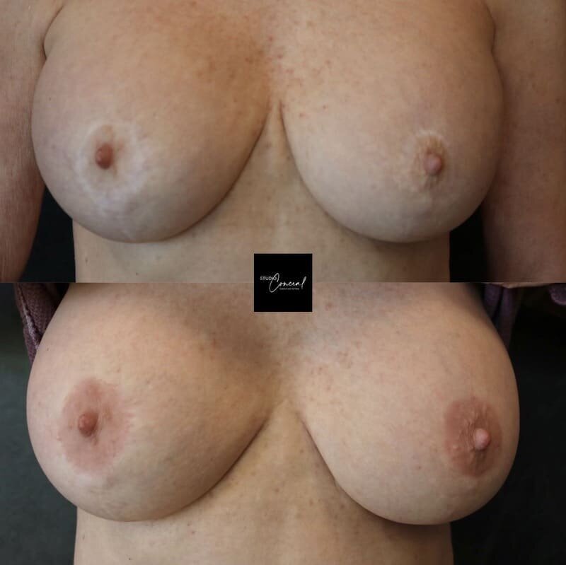 Nipple-Coloring-Rouging-2