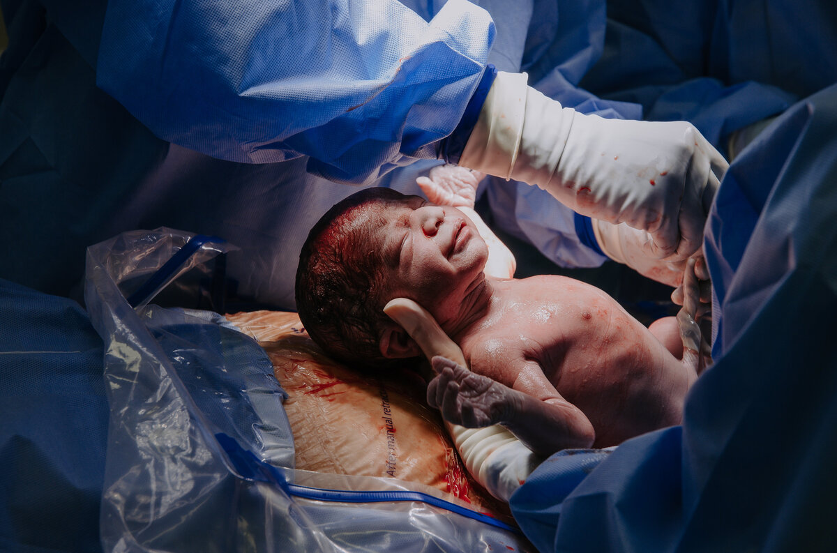 Docter holding baby born via C-Section in OR