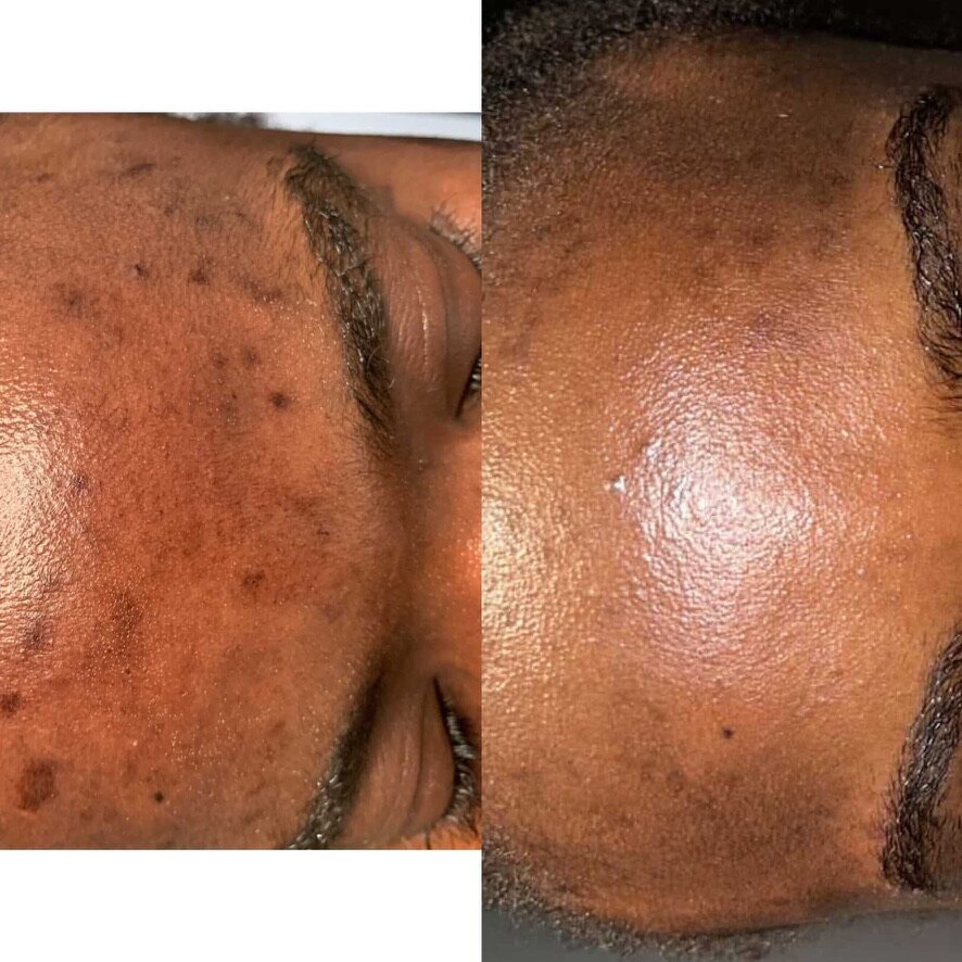 before & after a chemical peel