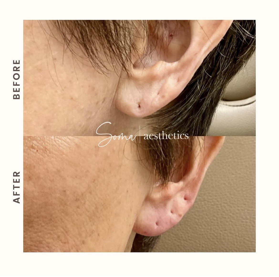 Earlobe dermal filler 