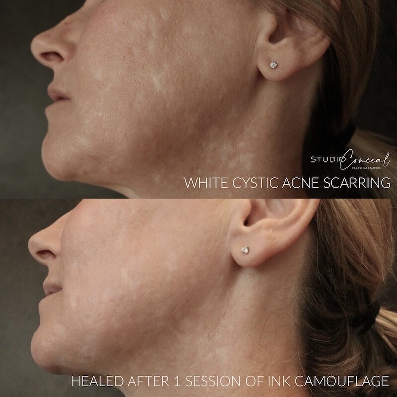  acne scar revision tattoo