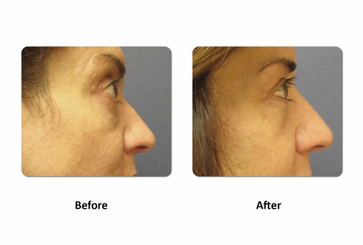 Li Medical Aesthetics Skin Tightening with VST Sinclair Before and After29