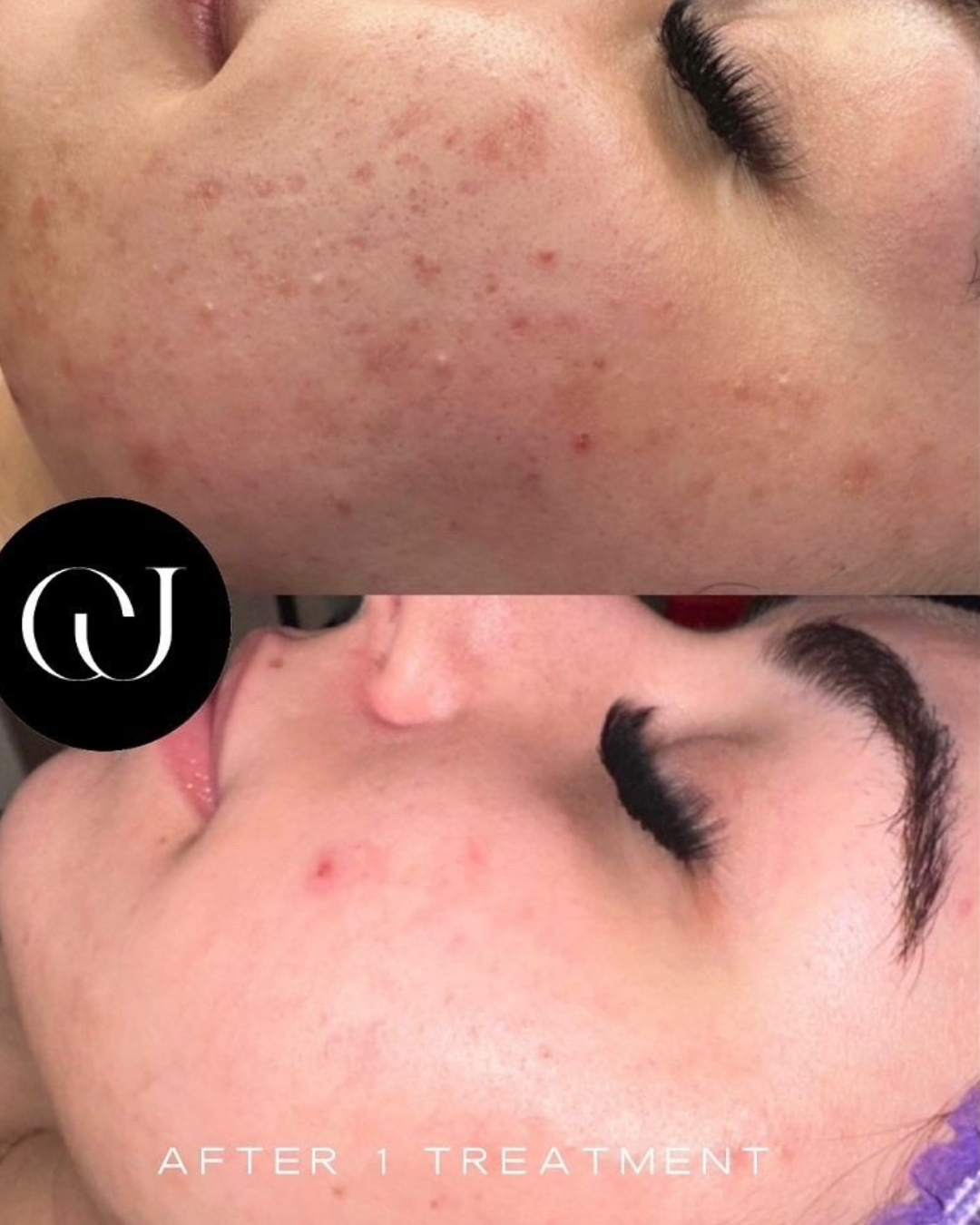 Resultaat Cloud Aesthetics Acne