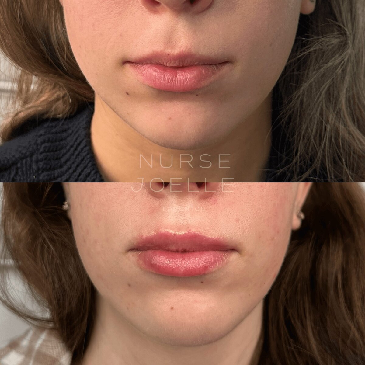 Nurse-Joelle-Cosmetic-Injectables-Before-and-After-17