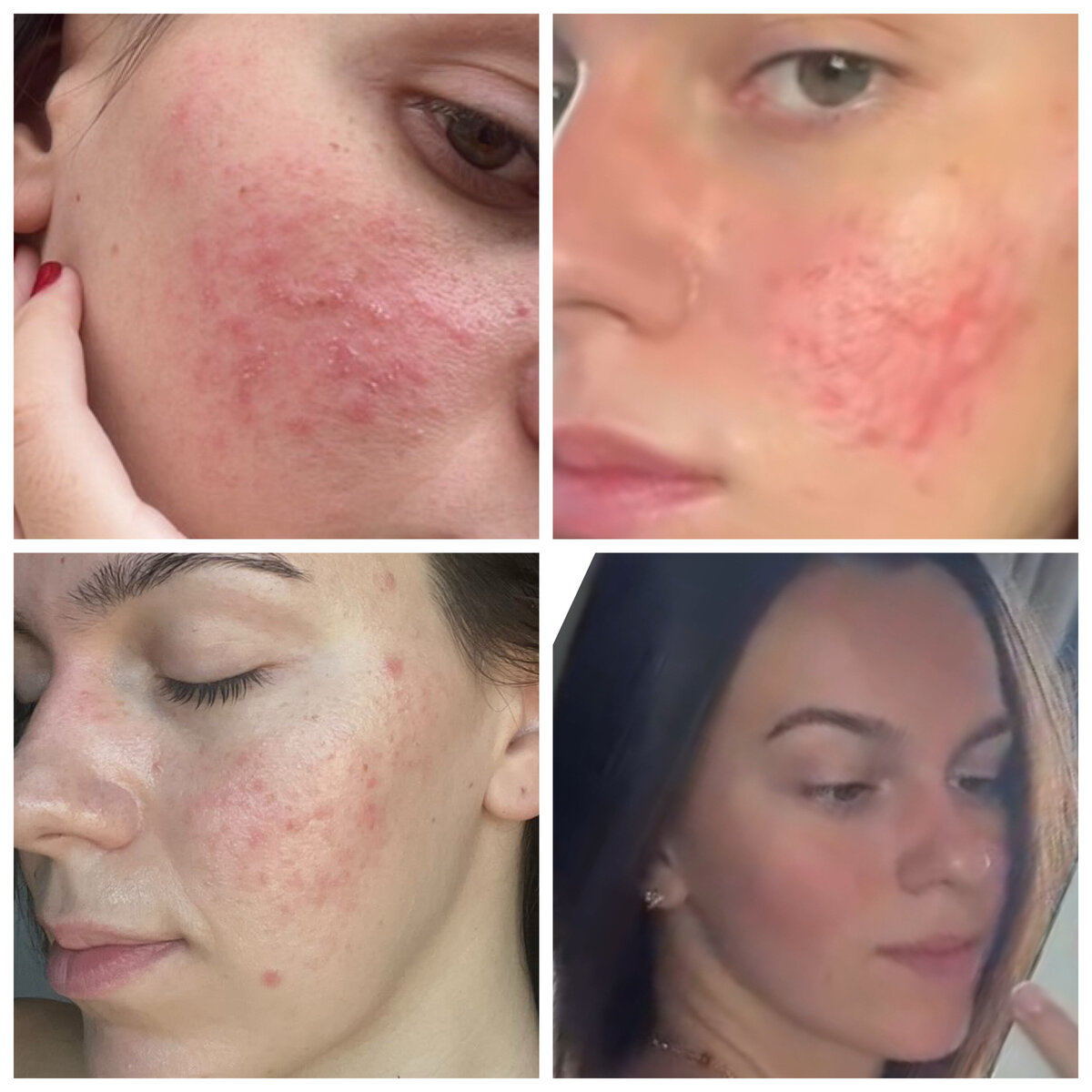 Before and after images showing reduced redness and acne rosacea with natural treatment methods.